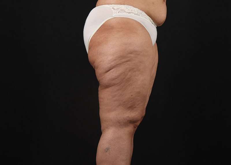 Thigh Lift Before & After Patient #1831