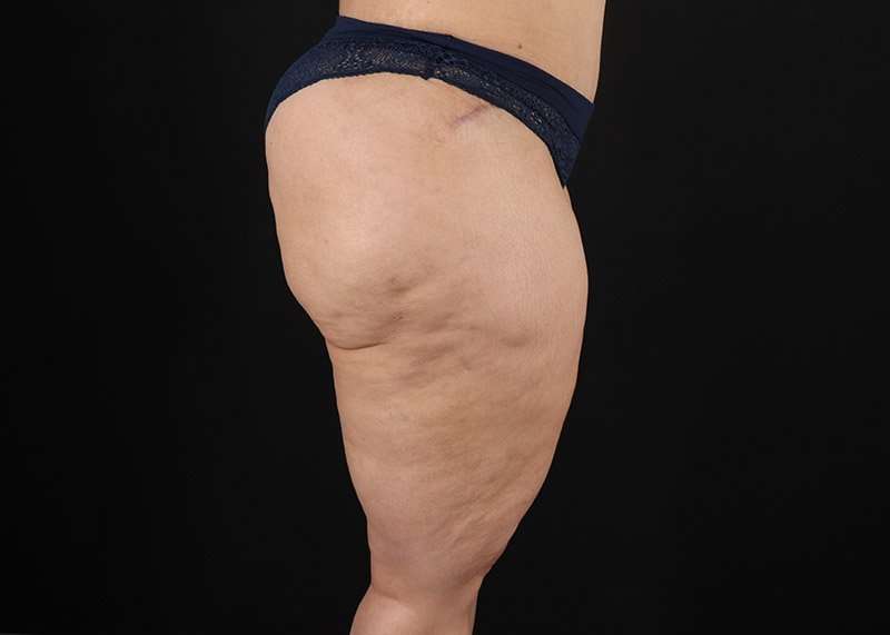 Thigh Lift Before & After Patient #1844