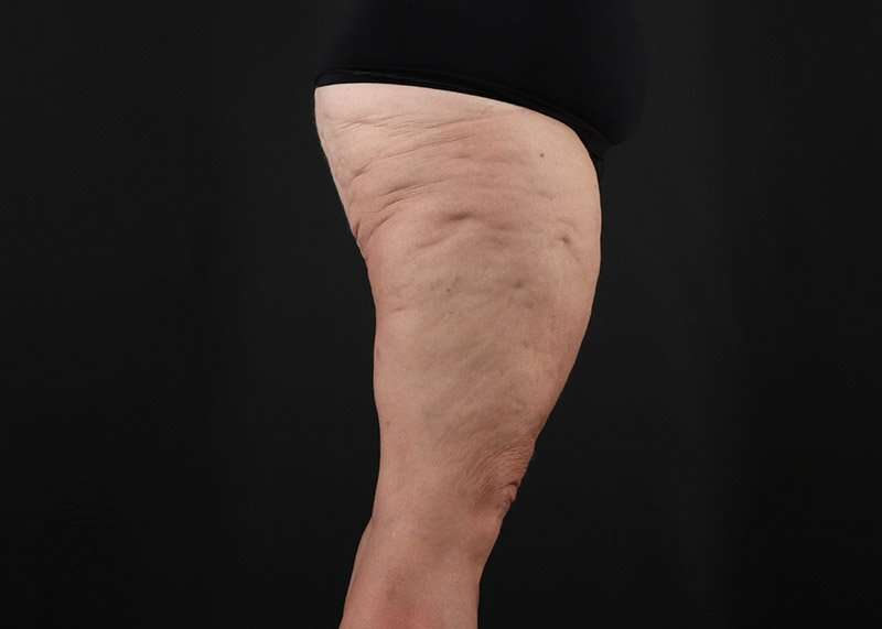 Thigh Lift Before & After Patient #1857