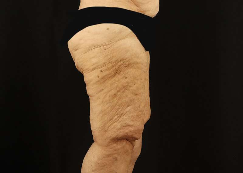 Thigh Lift Before & After Patient #1871
