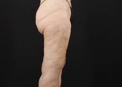Thigh Lift Before & After Patient #1884