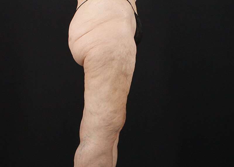 Thigh Lift Before & After Patient #1884