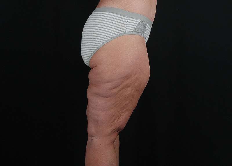 Thigh Lift Before & After Patient #1897