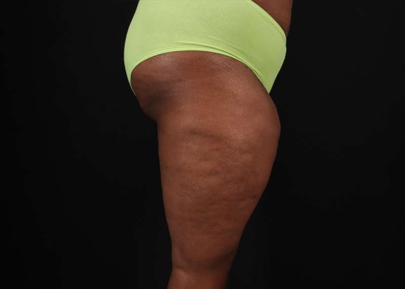 Thigh Lift Before & After Patient #1911