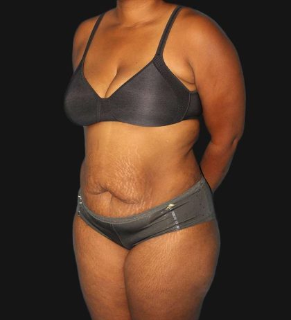 Abdominoplasty (Tummy Tuck) Before & After Patient #568