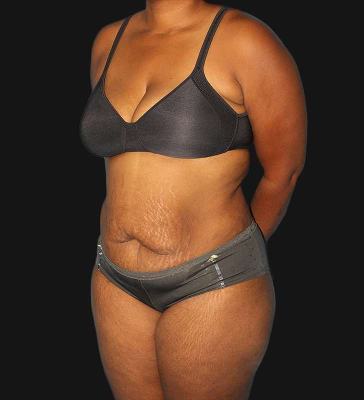 Abdominoplasty (Tummy Tuck) Before & After Patient #568