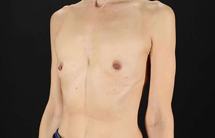Breast Augmentation Before & After Patient #2110
