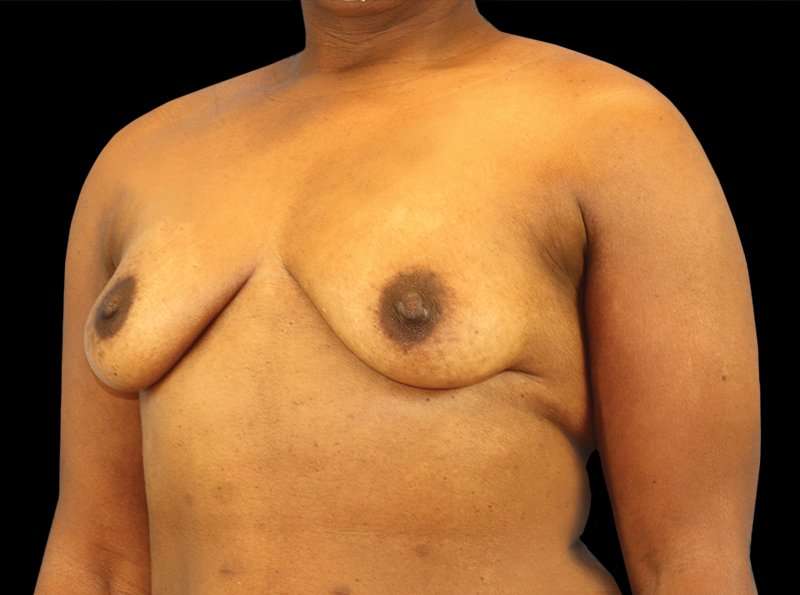 Breast Augmentation Before & After Patient #2121