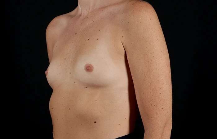 Breast Augmentation Before & After Patient #2365