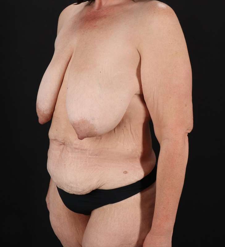 Breast Augmentation Before & After Patient #2389