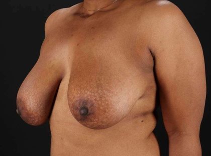Breast Reduction Before & After Patient #2452