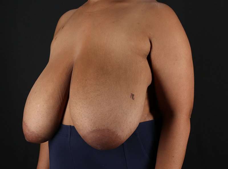Breast Reduction Before & After Patient #2463