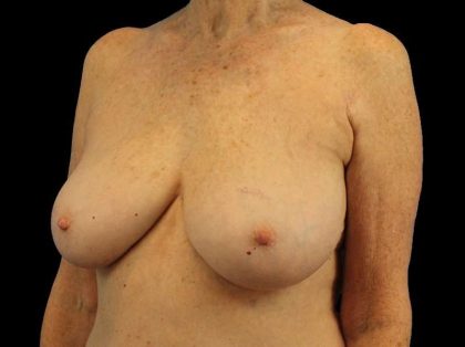 Breast Reduction Before & After Patient #2474