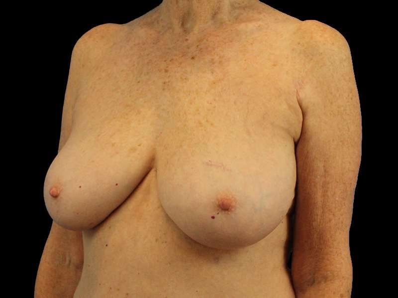Breast Reduction Before & After Patient #2474