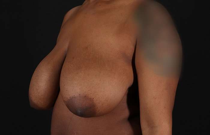 Breast Reduction Before & After Patient #2487