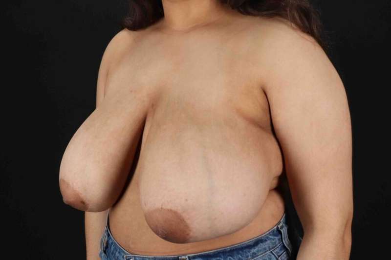 Breast Reduction Before & After Patient #2498