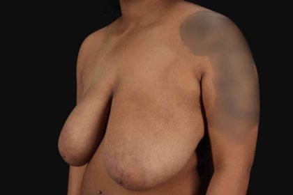 Breast Reduction Before & After Patient #2602