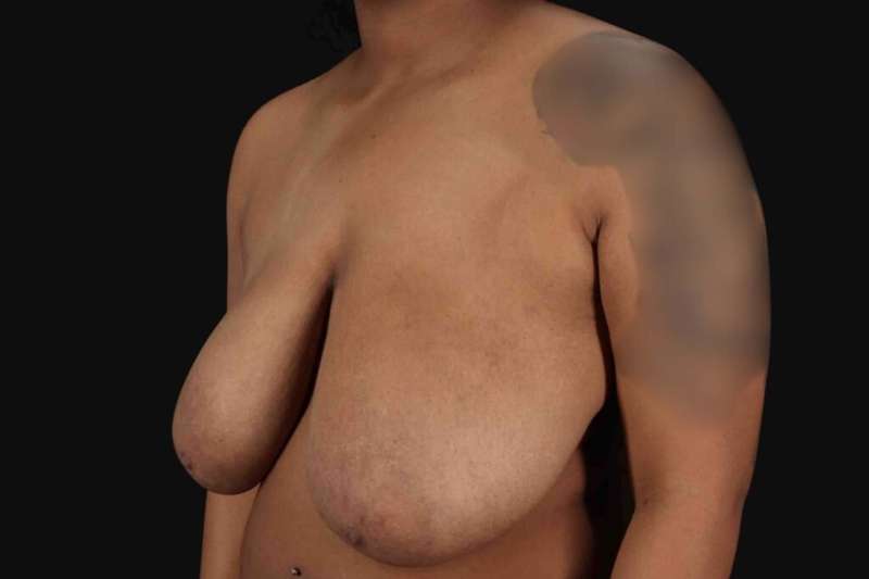 Breast Reduction Before & After Patient #2602