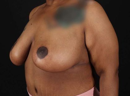 Breast Reduction Before & After Patient #2646