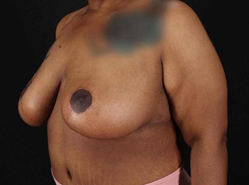 Breast Reduction Before & After Patient #2646