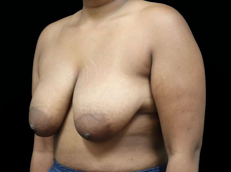 Breast Reduction Before & After Patient #2729