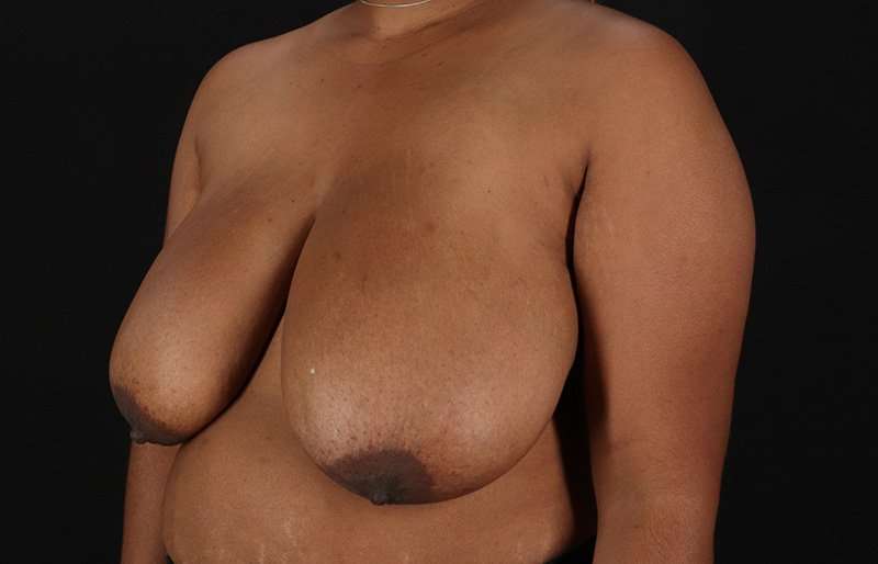 Breast Reduction Before & After Patient #2824