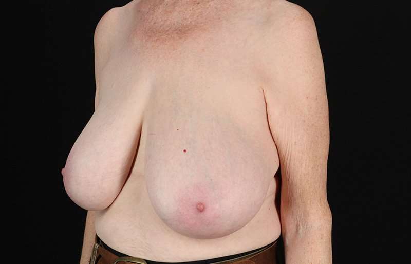 Breast Reduction Before & After Patient #2836