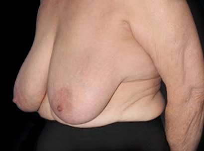 Breast Reduction Before & After Patient #2859
