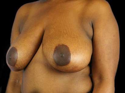 Breast Reduction Before & After Patient #2870