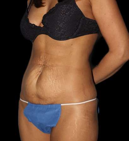 Abdominoplasty (Tummy Tuck) Before & After Patient #757