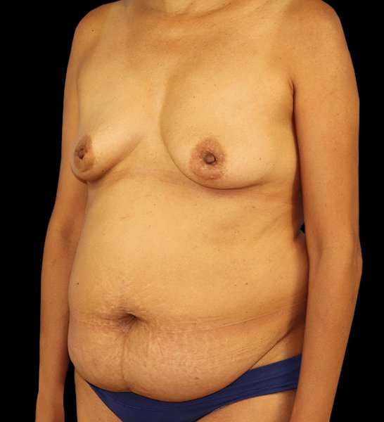 DIEP Flap Before & After Patient #3019