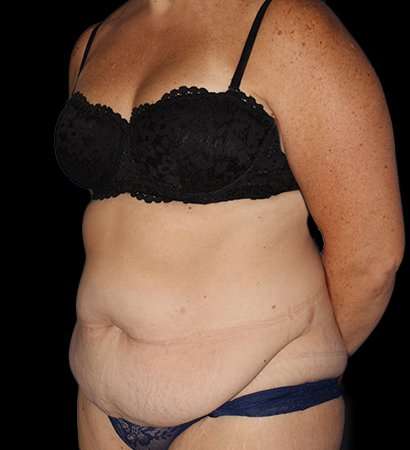 Abdominoplasty (Tummy Tuck) Before & After Patient #768