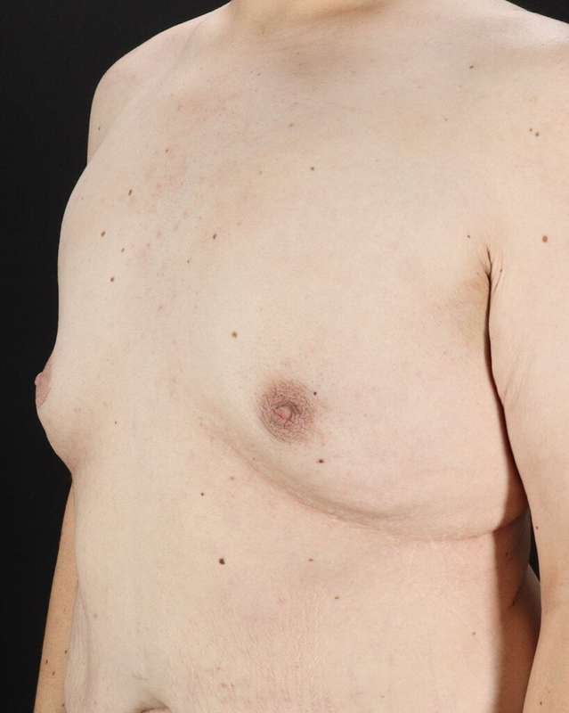 Gynecomastia Before & After Patient #3162