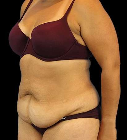 Abdominoplasty (Tummy Tuck) Before & After Patient #779