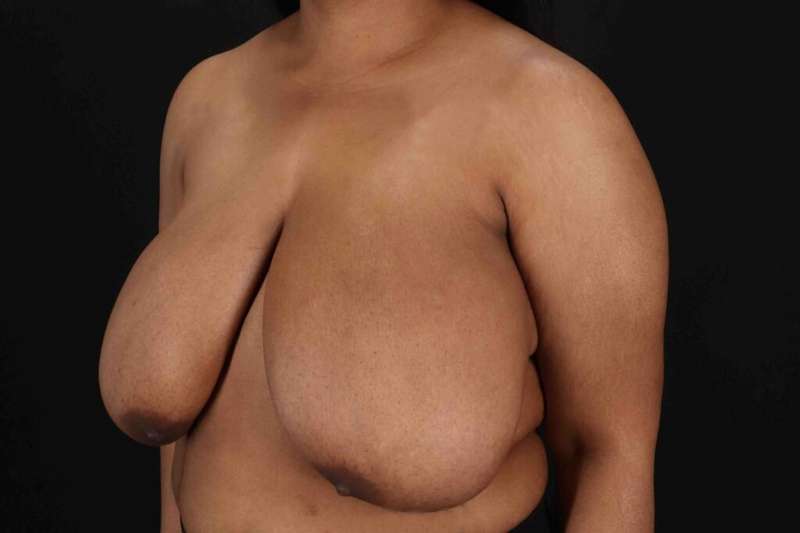 Breast Reduction With Lift Before & After Patient #3400