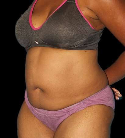 Abdominoplasty (Tummy Tuck) Before & After Patient #790