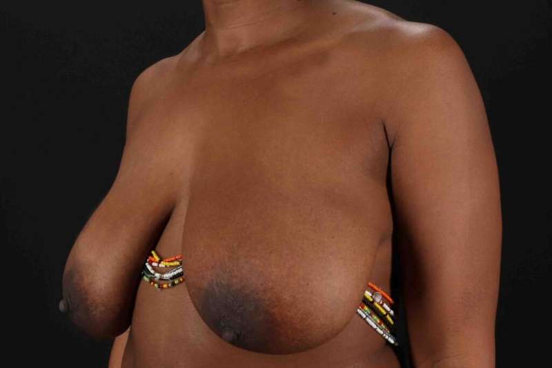 Breast Reduction With Lift Before & After Patient #3454
