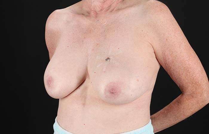 Implant Based Reconstruction Before & After Patient #3527