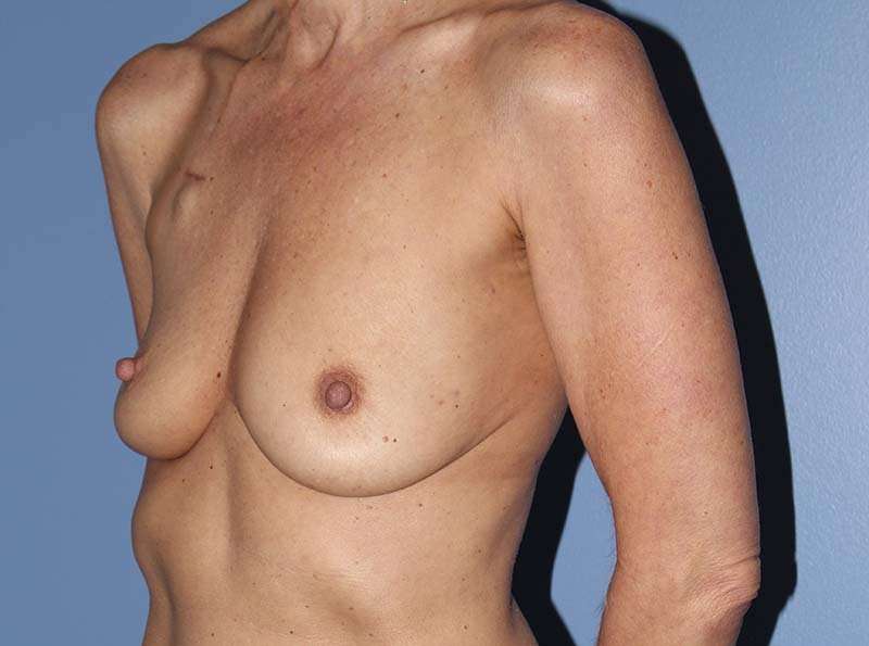 Implant Based Reconstruction Before & After Patient #3538
