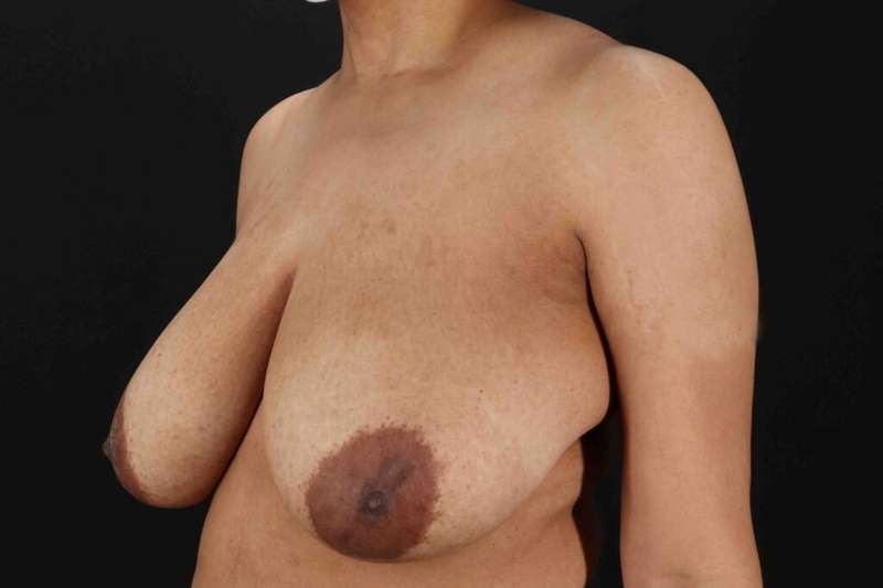 Breast Lift Before & After Patient #3626