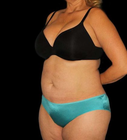 Abdominoplasty (Tummy Tuck) Before & After Patient #579