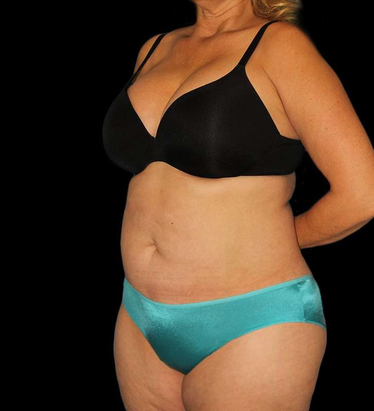 Abdominoplasty (Tummy Tuck) Before & After Patient #579