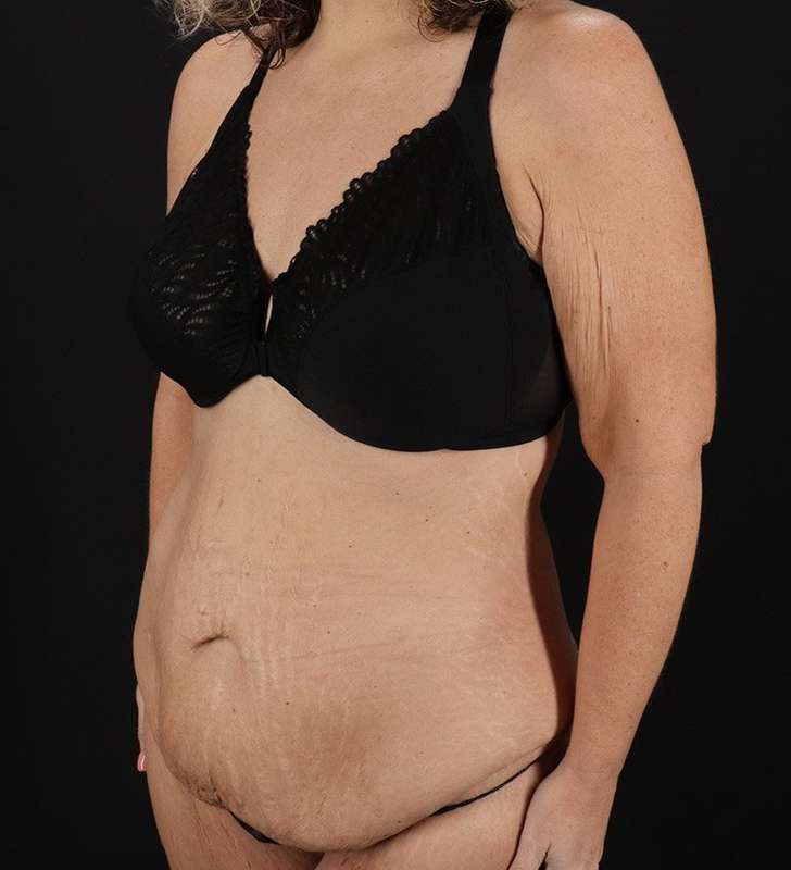 Abdominoplasty (Tummy Tuck) Before & After Patient #817