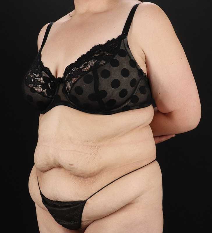Abdominoplasty (Tummy Tuck) Before & After Patient #830