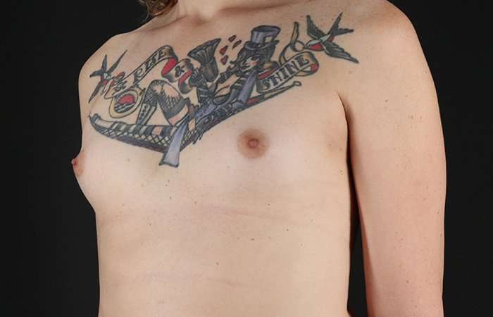Male To Female Breast Before & After Patient #3886