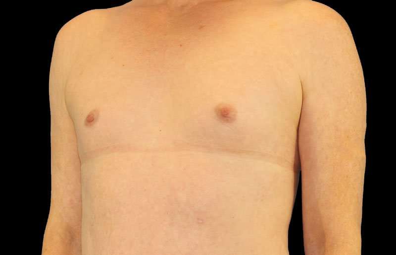 Male To Female Breast Before & After Patient #3911