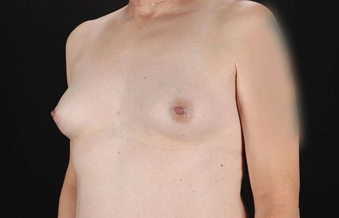 Male To Female Breast Before & After Patient #3922