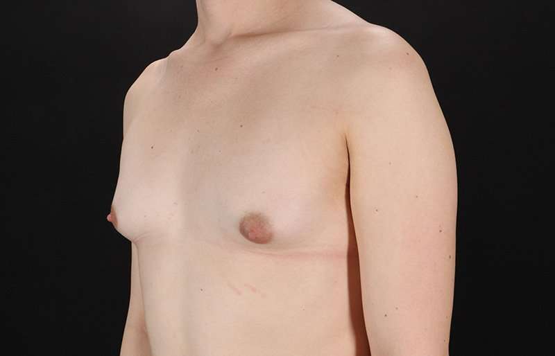 Male To Female Breast Before & After Patient #3933