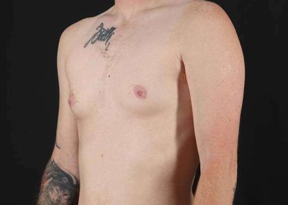 Female To Male Breast Before & After Patient #3955