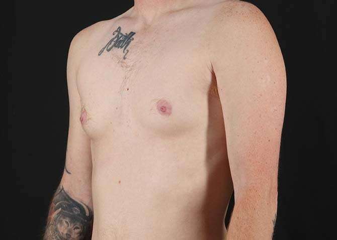 Female To Male Breast Before & After Patient #3955